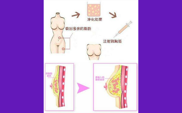自体脂肪丰胸过程