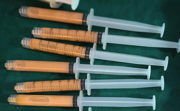 18岁以上可以做自体脂肪丰胸