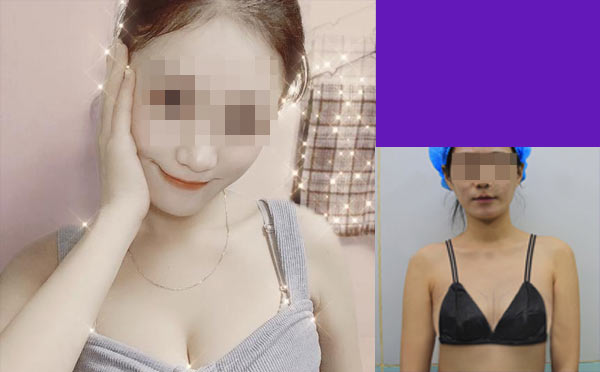 自体脂肪丰胸效果