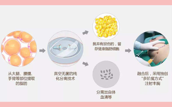 自体脂肪隆胸原理