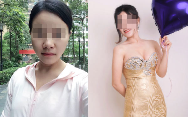 自体脂肪隆胸恢复时间