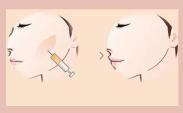 自体脂肪丰苹果肌手术价格怎么样?