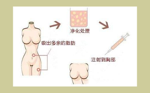 自体脂肪隆胸原理