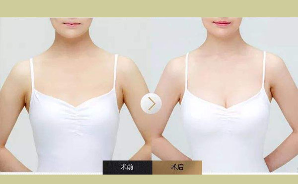 自体隆胸术前术后注意事项！