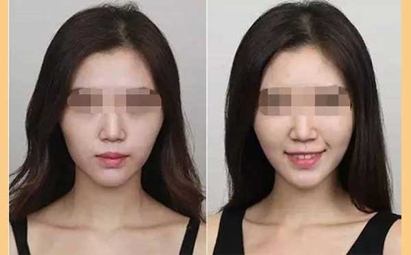 自体脂肪丰苹果肌的优势