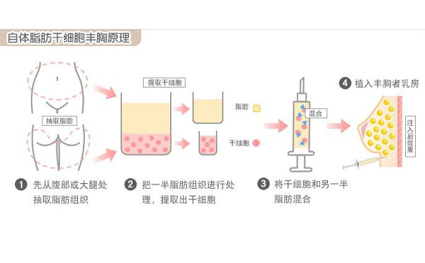 自体脂肪隆胸原理