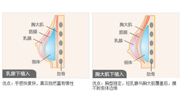 假体隆胸的过程