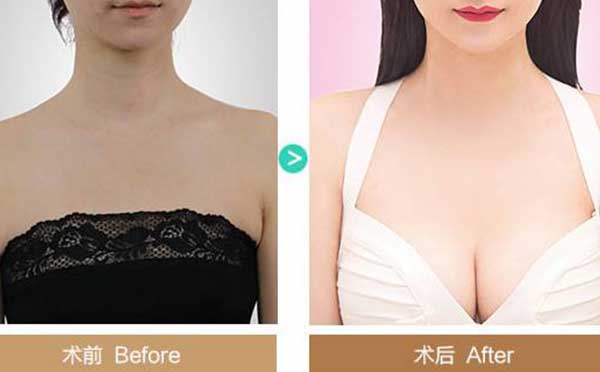 自体脂肪隆胸的优势