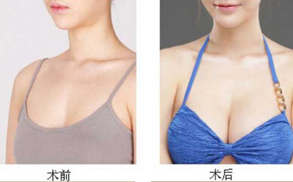 自体脂肪丰胸恢复期多久