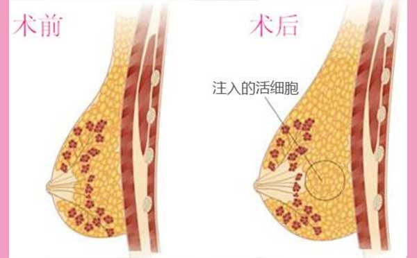 自体脂肪隆胸的优点