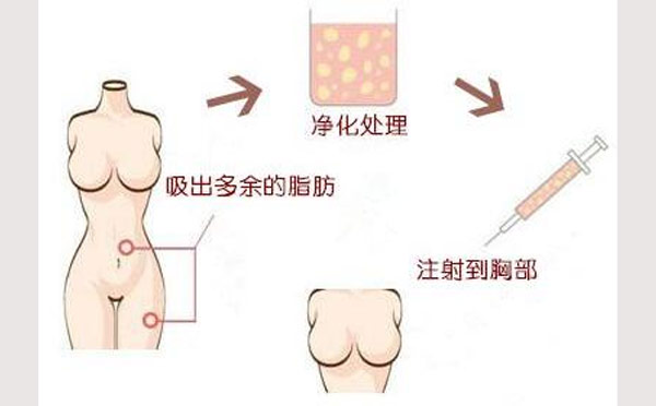 自体脂肪隆胸的原理