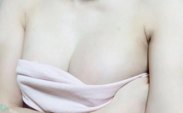 自体脂肪隆胸
