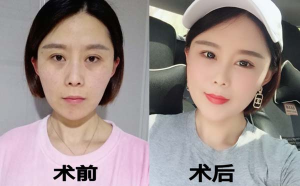 玻尿酸丰苹果肌效果能持续多久?